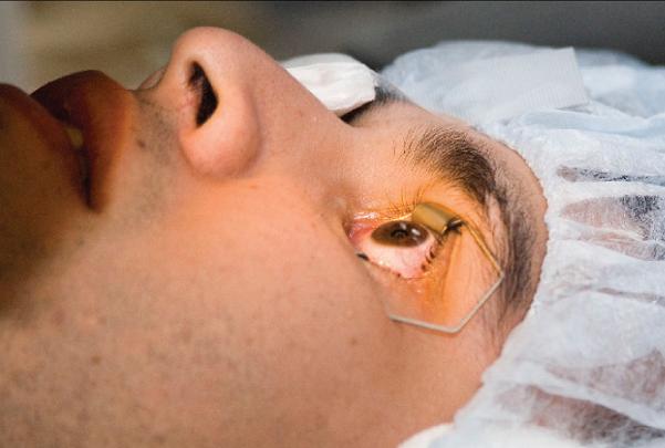 cirugia laser ojos