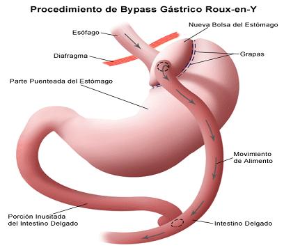 Bypass gástrico