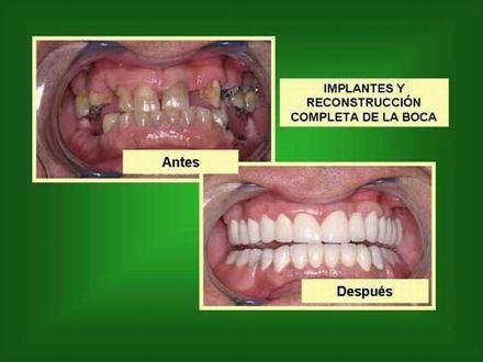 Implantes dentales