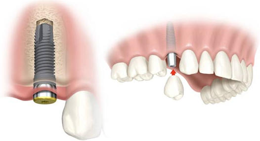 Precio de un implante dental