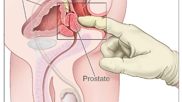Análisis de próstata podría ser dañino