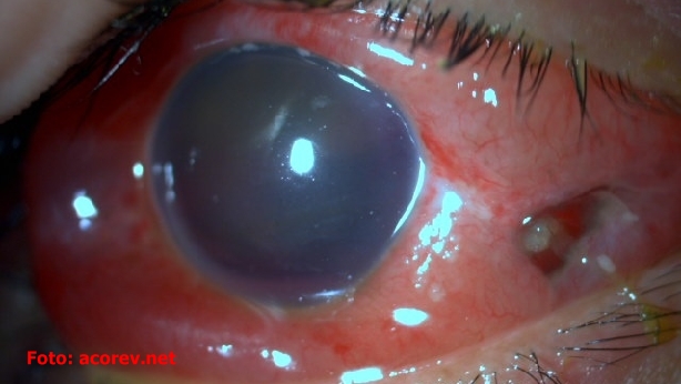 Riesgos de introducirse cuerpos extraños