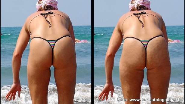 Cuidado con tratamientos de celulitis