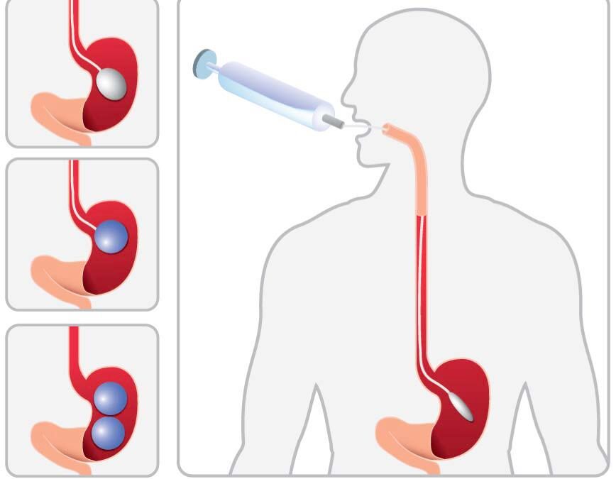 El Balon Intragastrico un revolucionario tratamiento medico